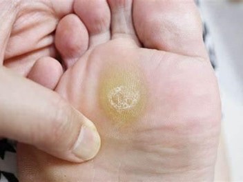 Solusi Cegah Kaki Kapalan